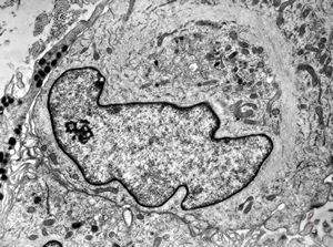 F, 49y. | myelosarcoma … histiocyte-like cells in dermal infiltrates F, 49y. | myelosarcoma … histiocyte-like cells in dermal infiltrates